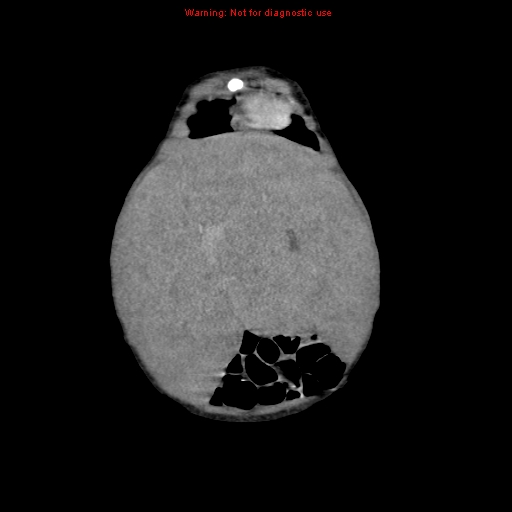 File:Neonatal neuroblastoma (Radiopaedia 9564-10223 B 29).jpg