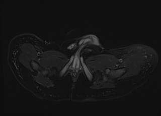 Neonatal prostatic utricle abscess - cyst (Radiopaedia 69511-79394 Axial T2 fat sat 4).jpg