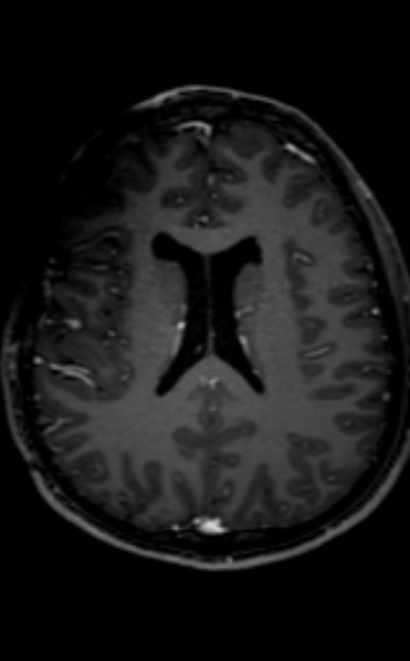 Neuro-Behçet disease (Radiopaedia 90112-107294 Axial T1 C+ 110).jpg