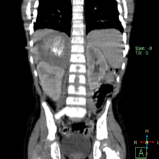 File:Neuroblastoma (Radiopaedia 24751-25016 B 18).jpg