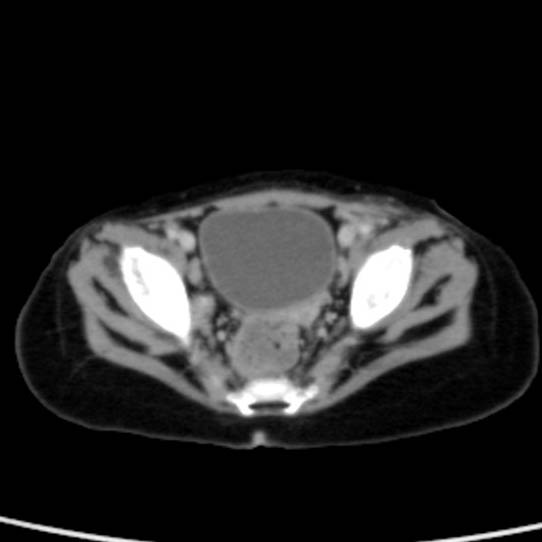 Neuroblastoma with skull metastases (Radiopaedia 30326-30960 C 54).jpg