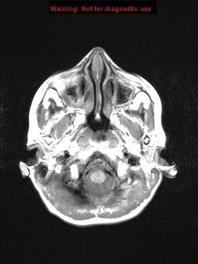 File:Neurofibromatosis type 1 with optic nerve glioma (Radiopaedia 16288-15965 Axial T1 22).jpg