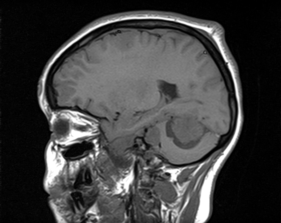 File:Neurofibromatosis type 2 (Radiopaedia 66211-75401 Sagittal T1 9).jpg
