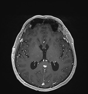 Neurofibromatosis type 2 (Radiopaedia 79097-92049 Axial T1 C+ 106).jpg