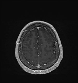 Neurofibromatosis type 2 (Radiopaedia 79097-92049 Axial T1 C+ 163).jpg