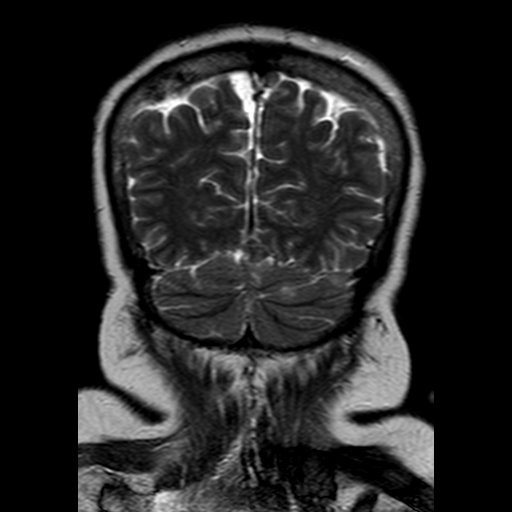 File:Neurofibromatosis type 2 (Radiopaedia 8713-9518 Coronal T2 21).jpg