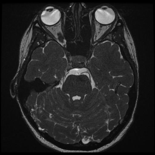 Neurofibromatosis type 2 - bilateral acoustic neuromata (Radiopaedia 40060-42566 Axial FIESTA 61).png