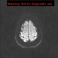 File:Neuroglial cyst (Radiopaedia 10713-11184 Axial DWI 26).jpg