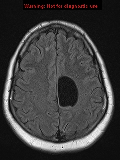 File:Neuroglial cyst (Radiopaedia 10713-11184 Axial FLAIR 6).jpg