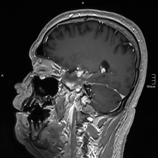 Neurosarcoidosis - involvement of the mesial temporal lobes (Radiopaedia 67429-76820 Sagittal T1 C+ 61).jpg