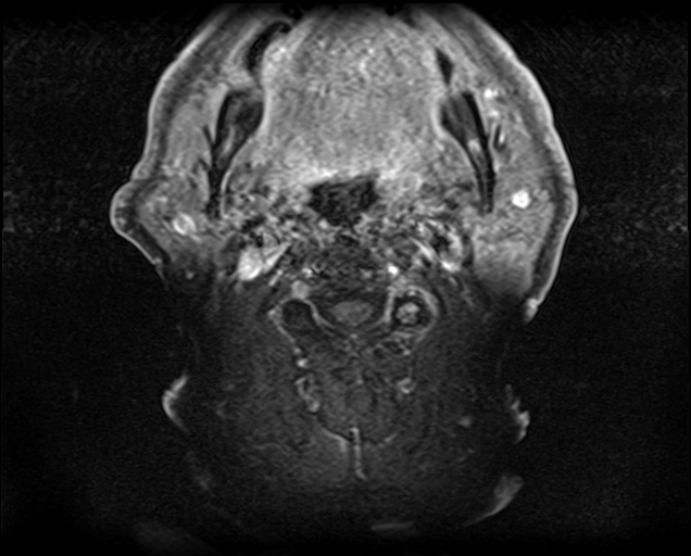 File:Non-Hodgkin lymphoma - parotid gland (Radiopaedia 71531-81890 Axial T1 C+ fat sat 10).jpg