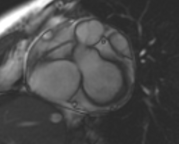 File:Non-compaction of the left ventricle (Radiopaedia 69436-79314 Short axis cine 188).jpg