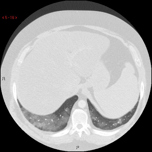 File:Non-specific interstitial pneumonitis (Radiopaedia 27044-27222 Axial lung window 7).jpg