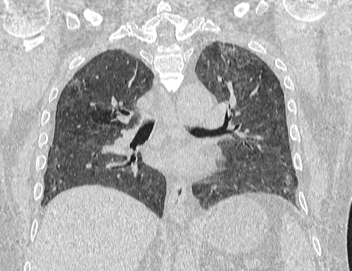 Non specific interstitial pneumonia (NSIP) (Radiopaedia 89725-106798 Coronal lung window 45).jpg