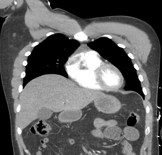 File:Normal CTA thorax (non ECG gated) (Radiopaedia 41750-44704 B 30).png