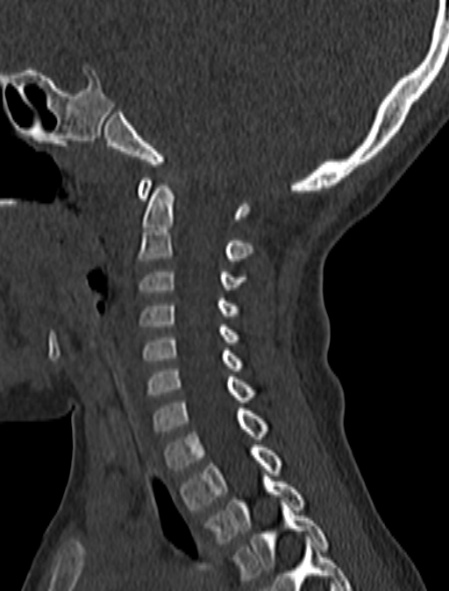 Normal CT cervical spine - pediatric (Radiopaedia 52549-58462 Sagittal bone window 120).jpg