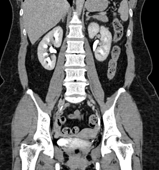 Normal CT intravenous urogram (Radiopaedia 39444-41759 A 292).jpg