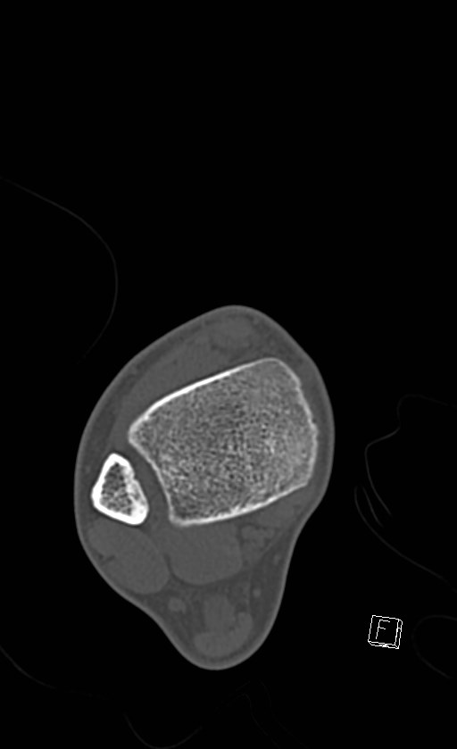 Normal CT of the ankle (Radiopaedia 47111-51658 Axial bone window 26).jpg