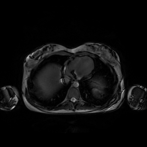 File:Normal MRI abdomen in pregnancy (Radiopaedia 88001-104541 Axial Gradient Echo 3).jpg