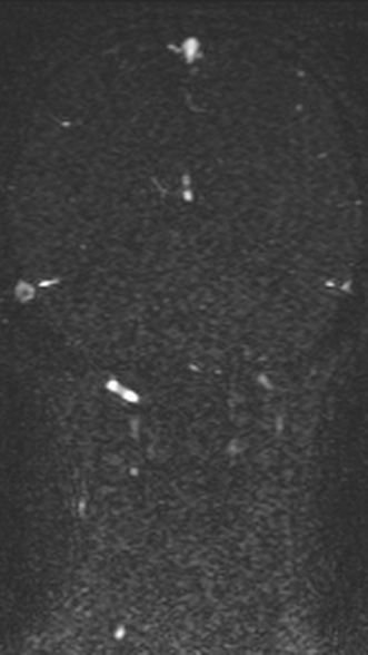 Normal MRI brain with MRV- teenager (Radiopaedia 49425-54553 Coronal MRV 176).jpg