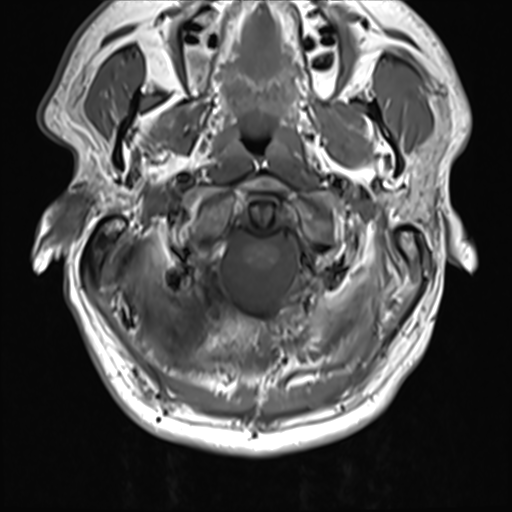 File:Normal MRI cervical spine (infection protocol) (Radiopaedia 53916-60039 Axial 8).png