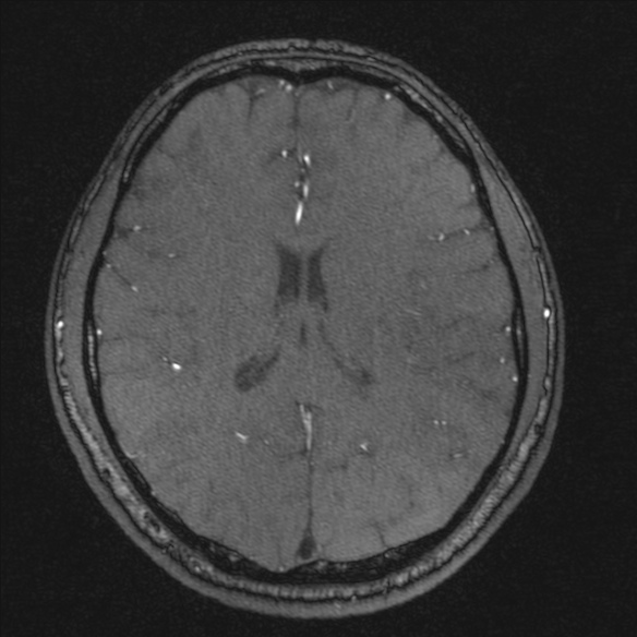 Normal brain MRI including MRA (Radiopaedia 48748-53763 Axial MRA 135).jpg