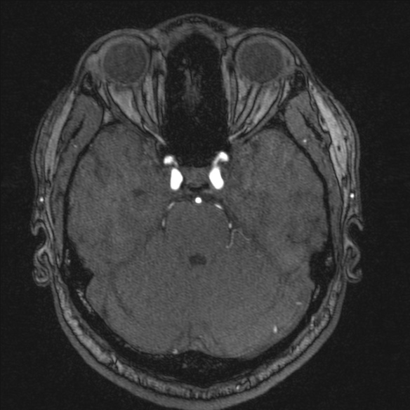 Normal brain MRI including MRA (Radiopaedia 48748-53763 Axial MRA 65).jpg