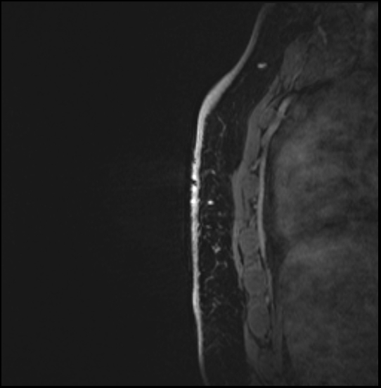 Normal breast MRI - dense breasts (Radiopaedia 80454-93850 I 159).jpg