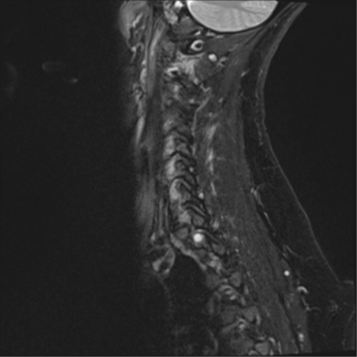 File:Normal cervical spine MRI (including Dixon) (Radiopaedia 42762-45925 Dixon- Water 14).png