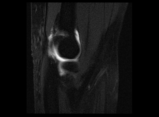 File:Normal elbow arthrograms (Radiopaedia 75550-86805 Sagittal T1 fat sat 8).jpg