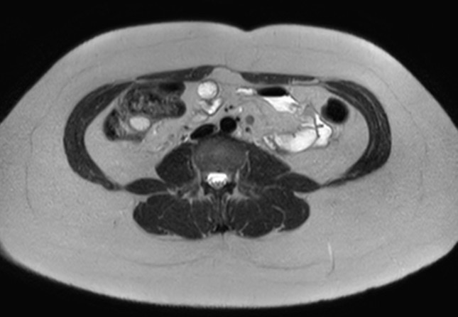 File:Normal liver MRI with Gadolinium (Radiopaedia 58913-66163 Axial T2 1).jpg