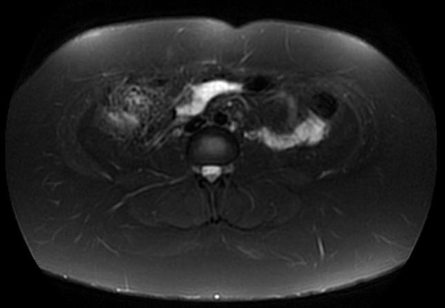 File:Normal liver MRI with Gadolinium (Radiopaedia 58913-66163 Axial T2 fat sat 6).jpg