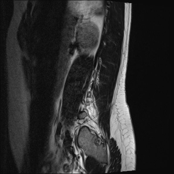 File:Normal lumbar spine MRI- 3 T (Radiopaedia 53280-59250 Sagittal T2 22).jpg