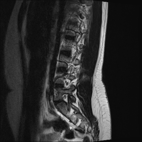 File:Normal lumbar spine MRI- 3 T (Radiopaedia 53280-59250 Sagittal T2 7).jpg