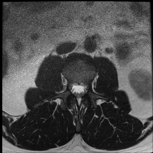 File:Normal lumbar spine MRI (Radiopaedia 35543-37039 Axial T2 30).png