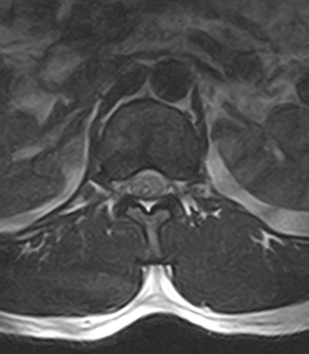 Normal lumbar spine MRI - low-field MRI scanner (Radiopaedia 40976-43699 Axial T2 20).jpg
