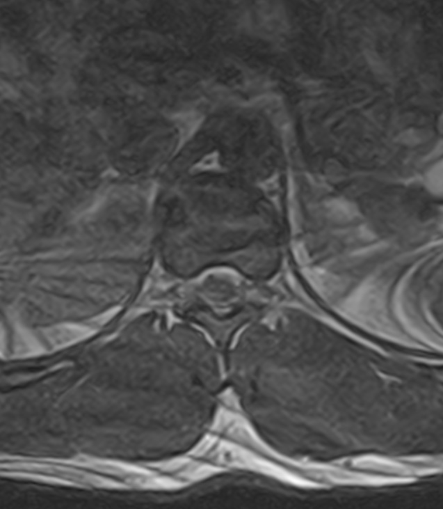 Normal lumbar spine MRI - low-field MRI scanner (Radiopaedia 40976-43699 Axial T2 4).jpg