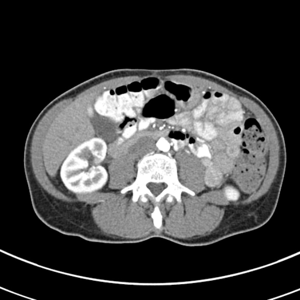File:Normal multiphase CT liver (Radiopaedia 38026-39996 B 47).jpg