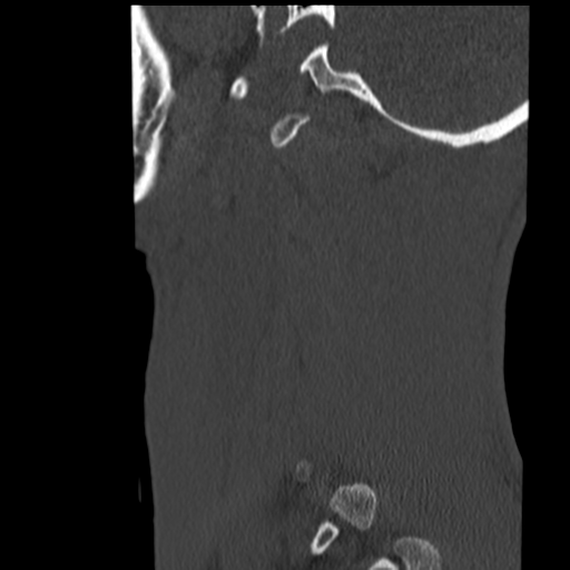 File:Normal trauma cervical spine (Radiopaedia 41017-43760 Sagittal bone window 45).png