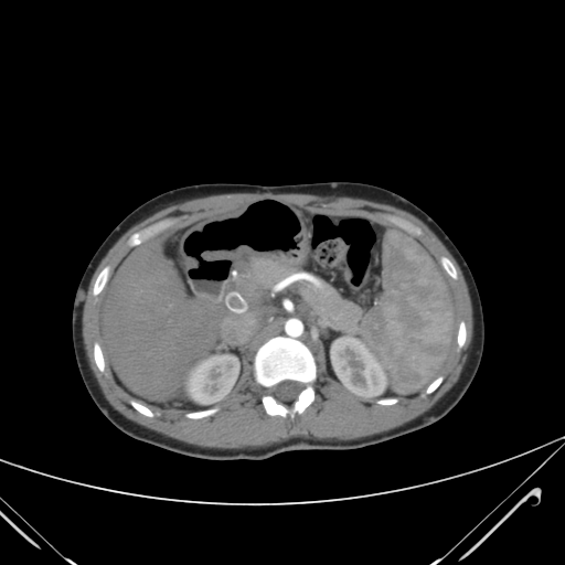 File:Nutmeg liver- Budd-Chiari syndrome (Radiopaedia 46234-50635 A 27).png