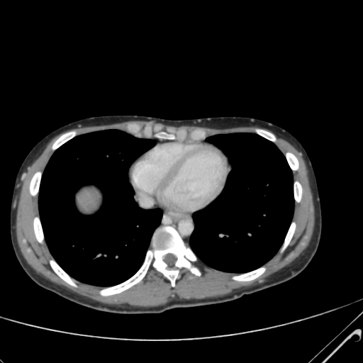 File:Nutmeg liver- Budd-Chiari syndrome (Radiopaedia 46234-50635 B 2).png