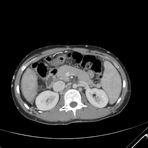 File:Nutmeg liver- Budd-Chiari syndrome (Radiopaedia 46234-50635 B 24).png