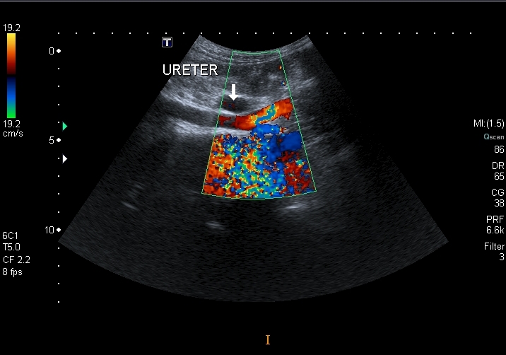 File:Obstructive uropathy and urolithiasis on ultrasound (Radiopaedia 25562-25758 D 1).jpg