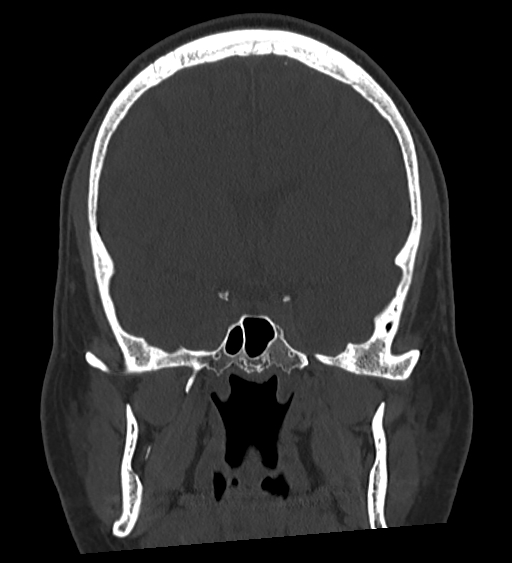 Occipital spur and Currarino type A atlas anomaly (Radiopaedia 87027-103285 Coronal bone window 71).jpg