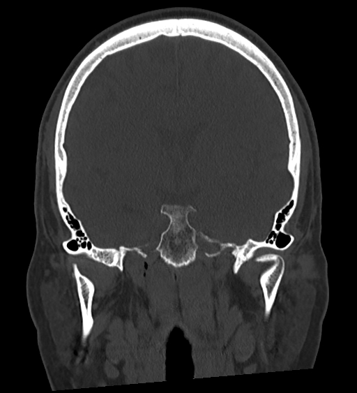 Occipital spur and Currarino type A atlas anomaly (Radiopaedia 87027-103285 Coronal bone window 78).jpg