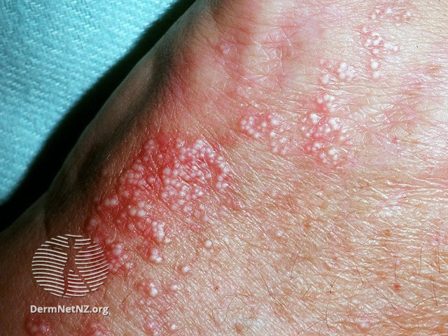 File:Porphyria cutanea tarda (DermNet NZ lesions-milia08).jpg