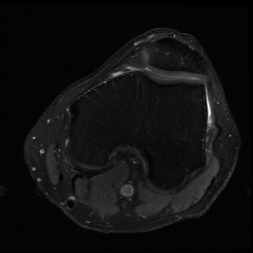 File:ACL and meniscal tears (Radiopaedia 79604-92797 Axial PD fat sat 10).jpg