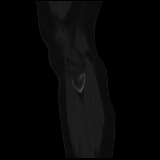 File:ACL avulsion fracture (Radiopaedia 33833-34994 Sagittal bone window 4).jpg