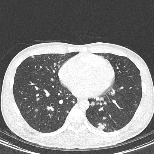 AIDS-related Kaposi sarcoma (Radiopaedia 85247-100811 Axial lung window 108).jpg