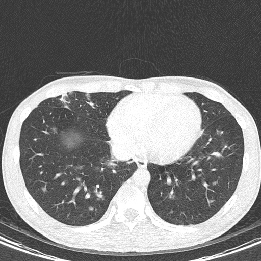 AIDS-related Kaposi sarcoma (Radiopaedia 85247-100811 Axial lung window 127).jpg